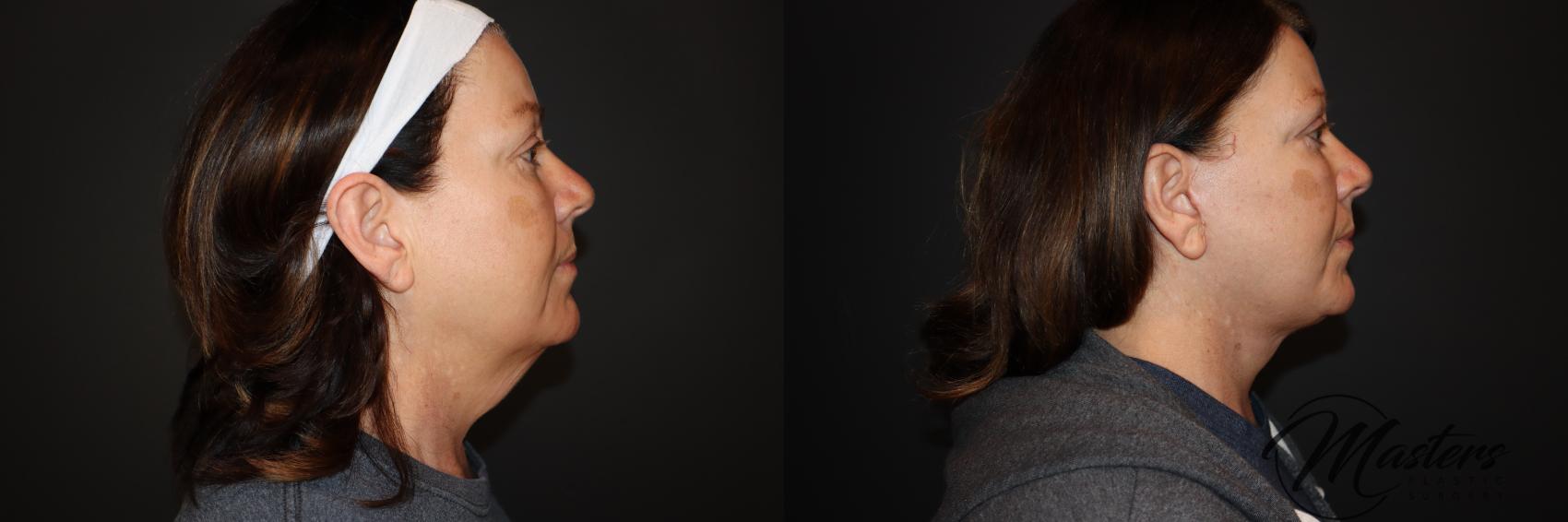 Face Lift Neck Lift 