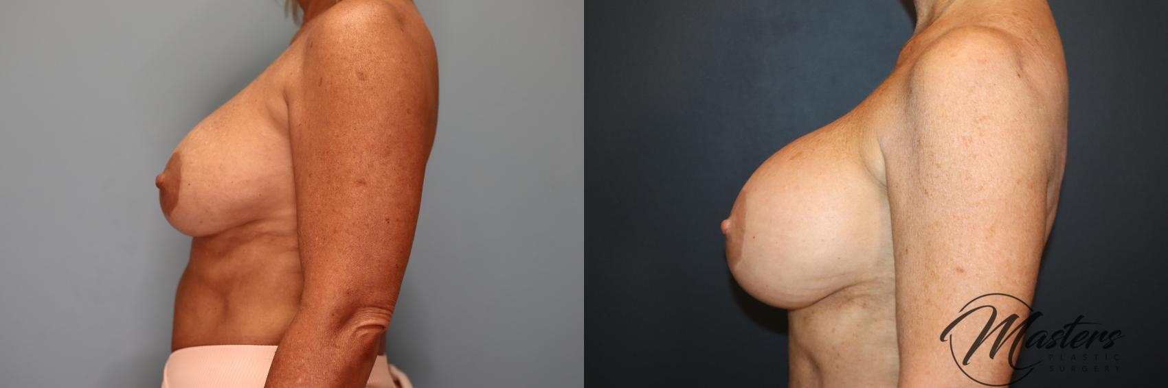 Before & After Implant Exchange  Case 103 Left Side View in Oklahoma City, Tulsa, Norman, OK