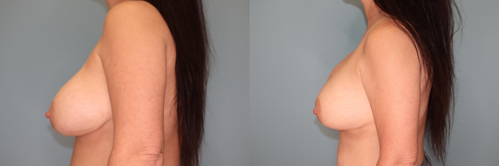 Before & After Implant Exchange  Case 68 Left Side View in Oklahoma City, Tulsa, Norman, OK