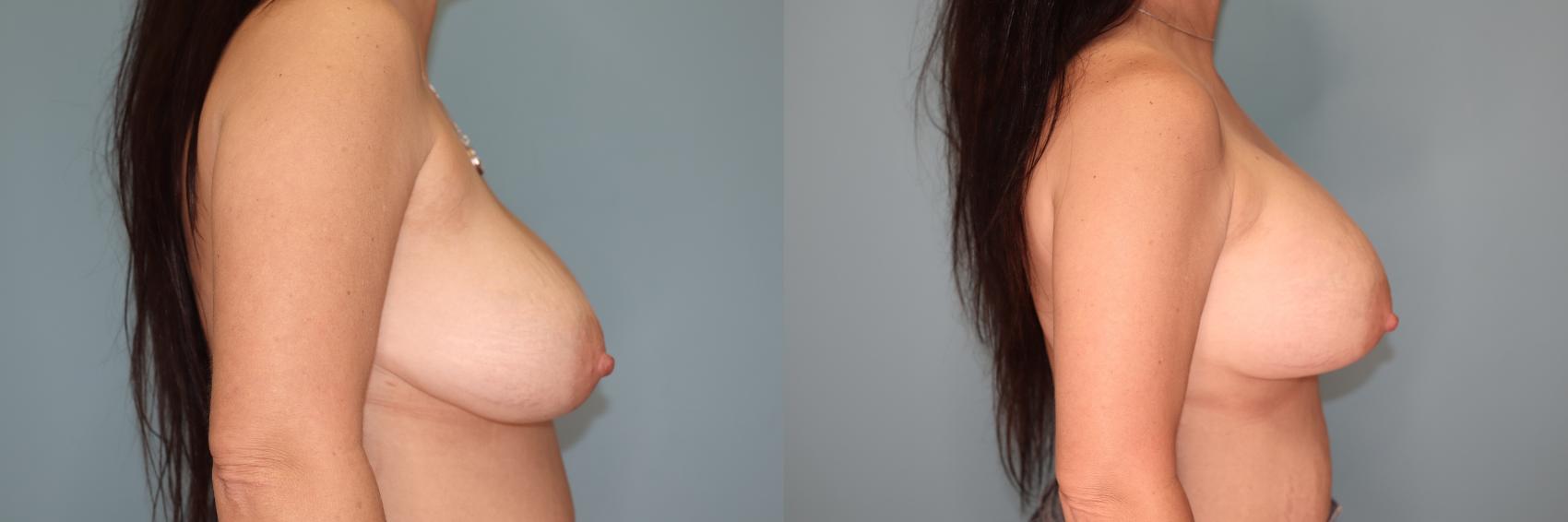 Before & After Implant Exchange  Case 68 Right Side View in Oklahoma City, Tulsa, Norman, OK