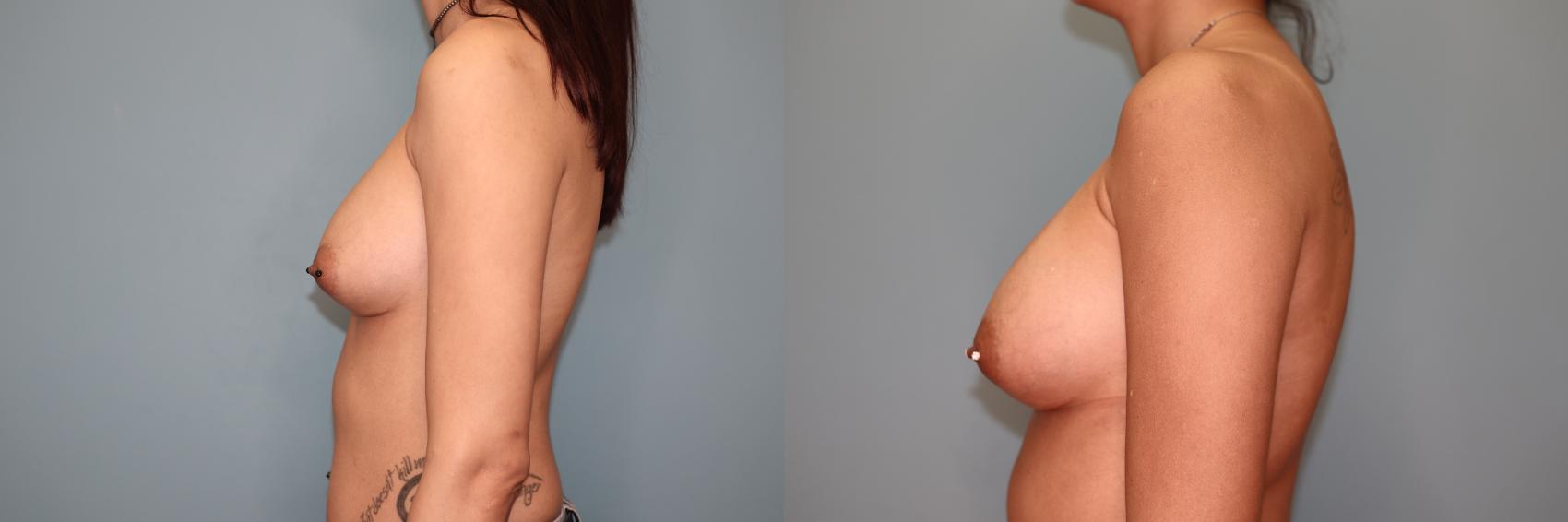 Before & After Implant Exchange  Case 69 Left Side View in Oklahoma City, Tulsa, Norman, OK