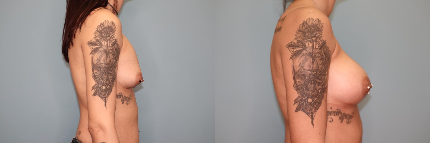 Before & After Implant Exchange  Case 69 Right Side View in Oklahoma City, Tulsa, Norman, OK