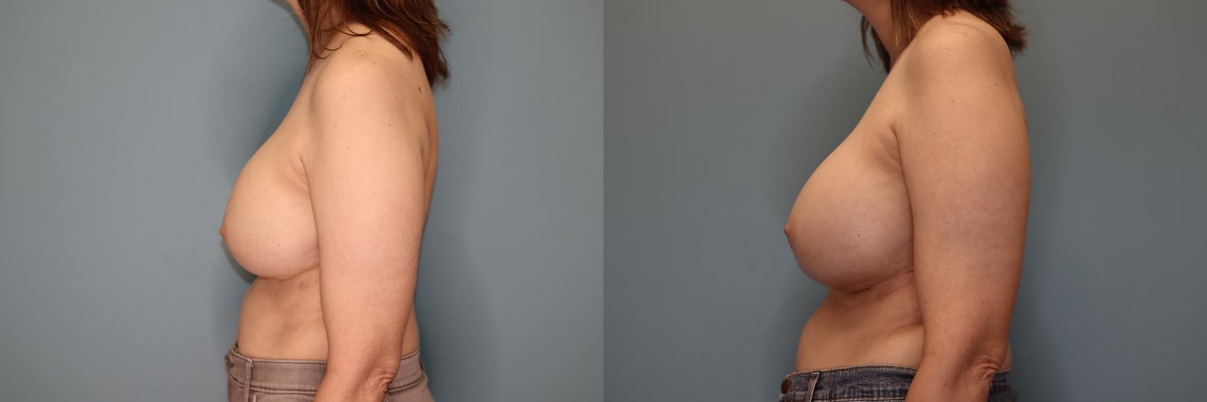 Before & After Implant Exchange  Case 71 Left Side View in Oklahoma City, Tulsa, Norman, OK