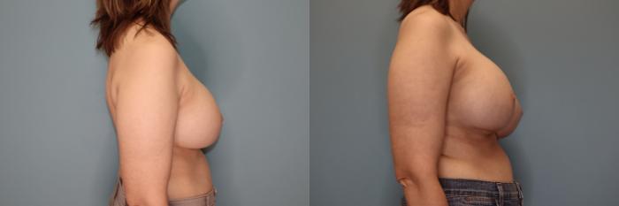Before & After Implant Exchange  Case 71 Right Side View in Oklahoma City, Tulsa, Norman, OK