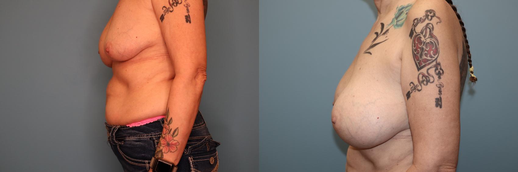 Before & After Implant Exchange  Case 72 Left Side View in Oklahoma City, Tulsa, Norman, OK