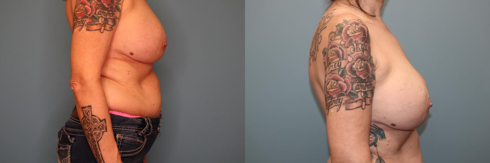 Before & After Implant Exchange  Case 72 Right Side View in Oklahoma City, Tulsa, Norman, OK