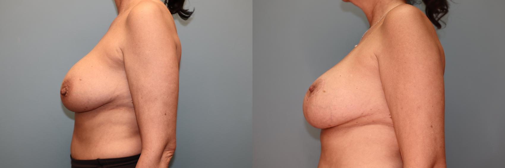 Before & After Implant Exchange with Lift  Case 73 Left Side View in Oklahoma City, Tulsa, Norman, OK