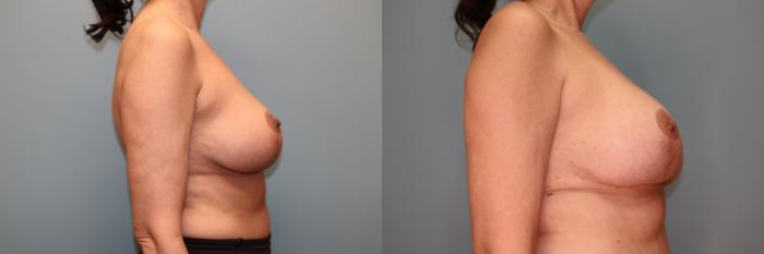 Before & After Implant Exchange with Lift  Case 73 Right Side View in Oklahoma City, Tulsa, Norman, OK