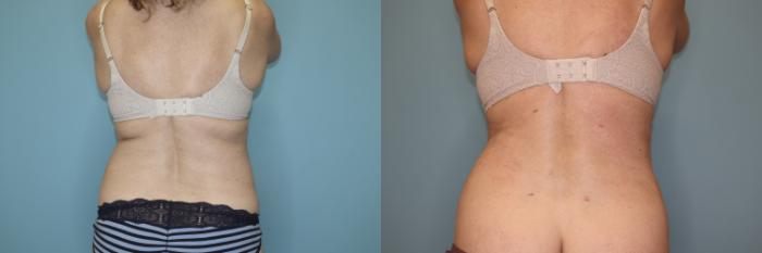 Before & After Liposuction Case 75 Back View in Oklahoma City, Tulsa, Norman, OK