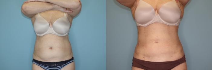 Before & After Liposuction Case 75 Front View in Oklahoma City, Tulsa, Norman, OK