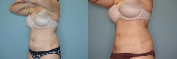 Before & After Liposuction Case 75 Left Oblique View in Oklahoma City, Tulsa, Norman, OK