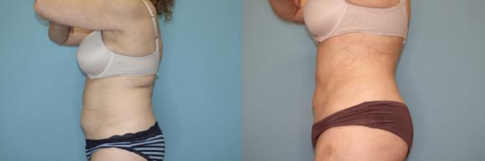 Before & After Liposuction Case 75 Left Side View in Oklahoma City, Tulsa, Norman, OK