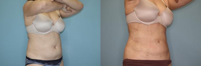 Before & After Liposuction Case 75 Right Oblique View in Oklahoma City, Tulsa, Norman, OK