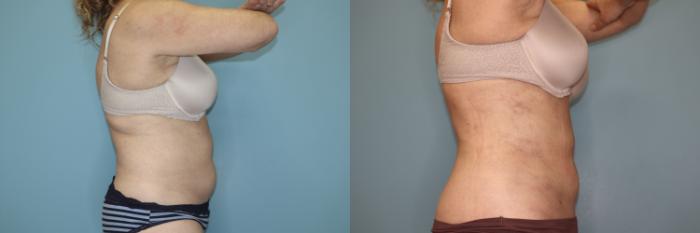Before & After Liposuction Case 75 Right Side View in Oklahoma City, Tulsa, Norman, OK