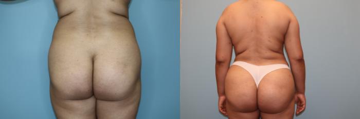 Before & After Liposuction Case 76 Back View in Oklahoma City, Tulsa, Norman, OK