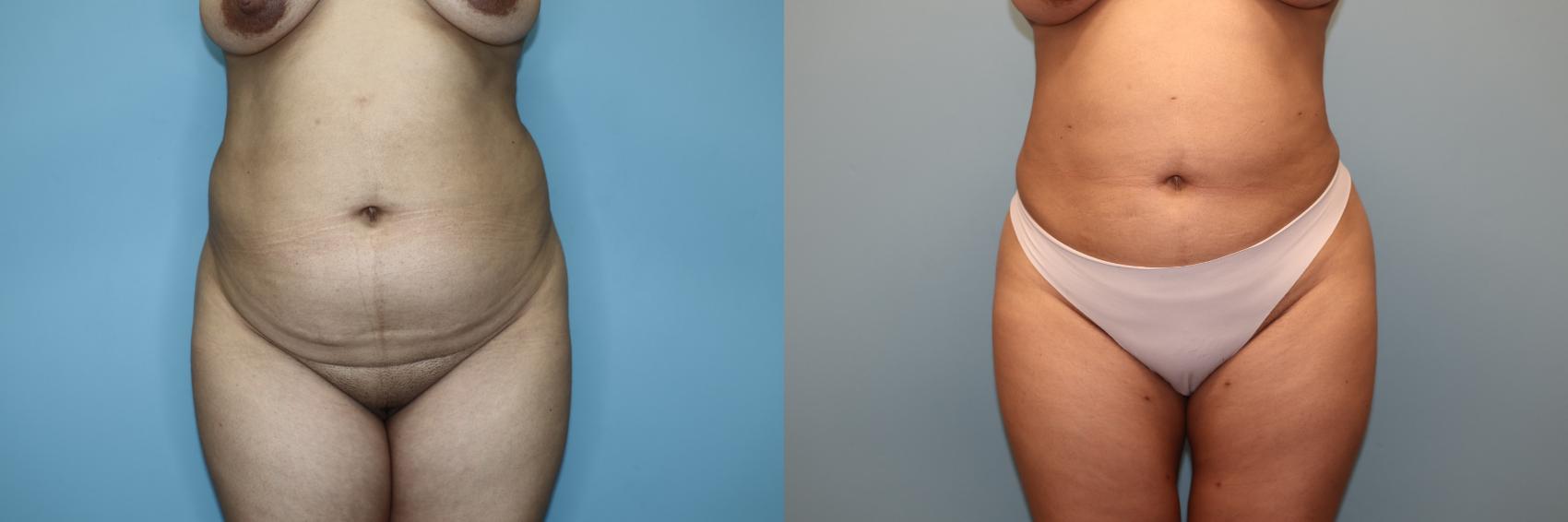 Before & After Liposuction Case 76 Front View in Oklahoma City, Tulsa, Norman, OK