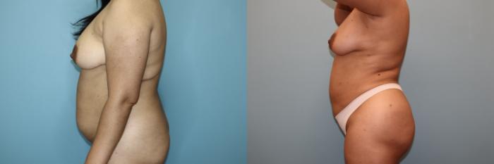 Before & After Liposuction Case 76 Left Side View in Oklahoma City, Tulsa, Norman, OK