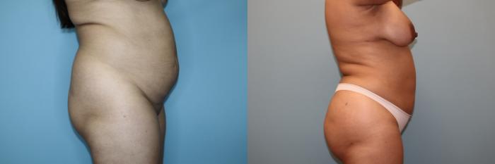 Before & After Liposuction Case 76 Right Side View in Oklahoma City, Tulsa, Norman, OK