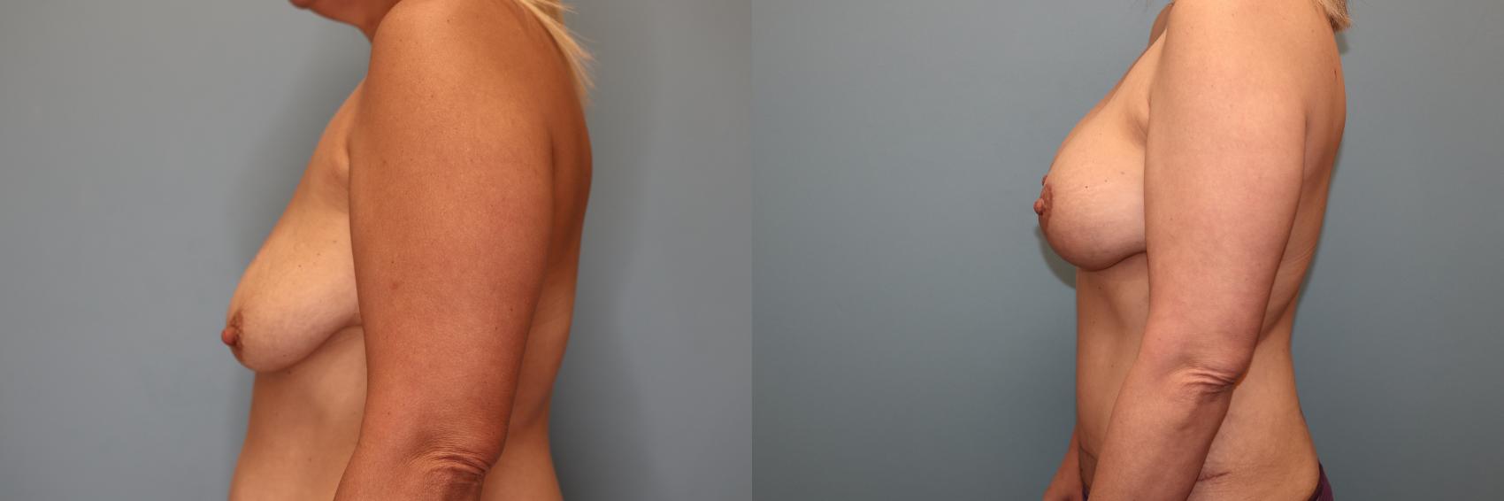 Before & After Mommy Makeover Case 84 Breast- Left  View in Oklahoma City, Tulsa, Norman, OK