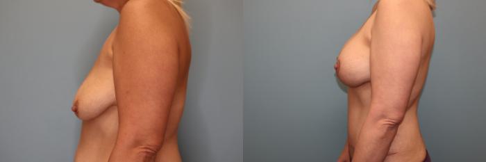 Before & After Mommy Makeover Case 84 Breast- Left  View in Oklahoma City, Tulsa, Norman, OK