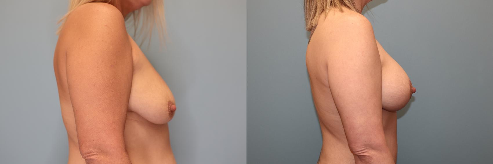Before & After Mommy Makeover Case 84 Breast- Right  View in Oklahoma City, Tulsa, Norman, OK