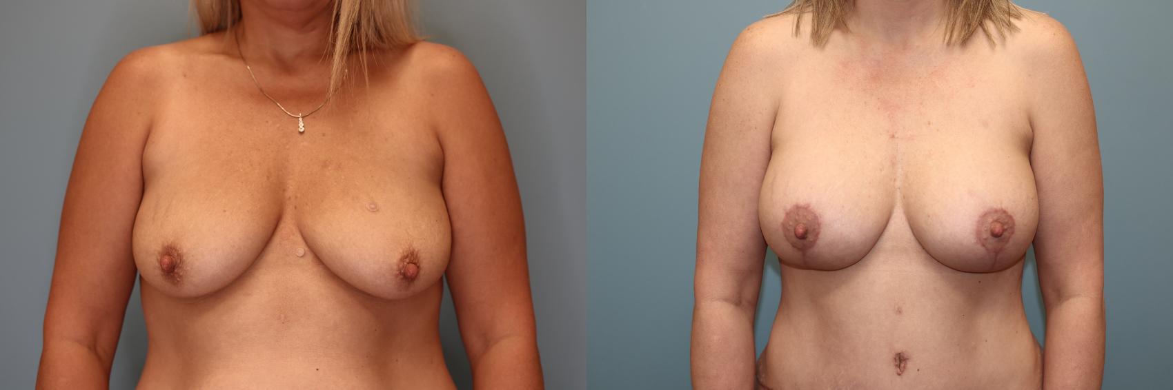 Before & After Mommy Makeover Case 84 Front Breast  View in Oklahoma City, Tulsa, Norman, OK