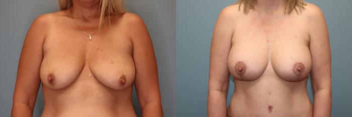 Before & After Tummy Tuck Case 84 Front Breast  View in Oklahoma City, Tulsa, Norman, OK