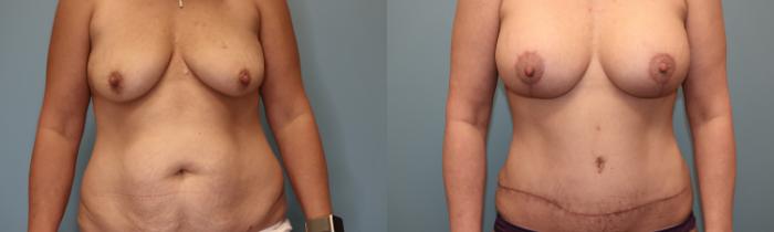 Before & After Tummy Tuck Case 84 Front View in Oklahoma City, Tulsa, Norman, OK