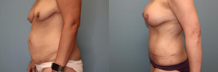Before & After Breast Augmentation with Lift Case 84 Left Side View in Oklahoma City, Tulsa, Norman, OK