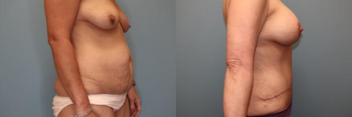 Before & After Breast Augmentation with Lift Case 84 Right Side View in Oklahoma City, Tulsa, Norman, OK