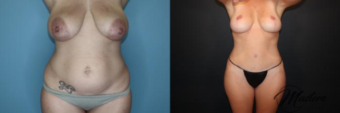 Mommy Makeover Breast Lift Breast Augmentation Tummy tuck