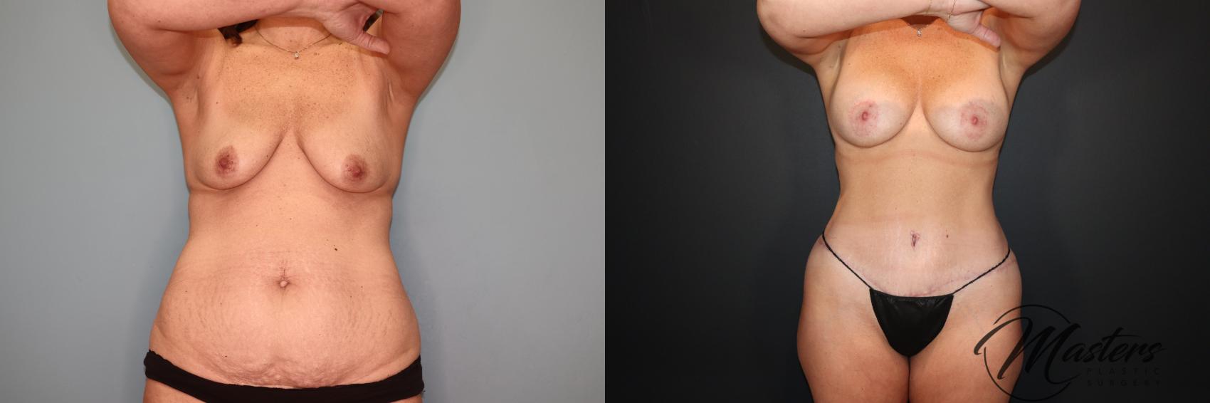 Mommy Makeover Breast Lift Breast Augmentation Tummy tuck