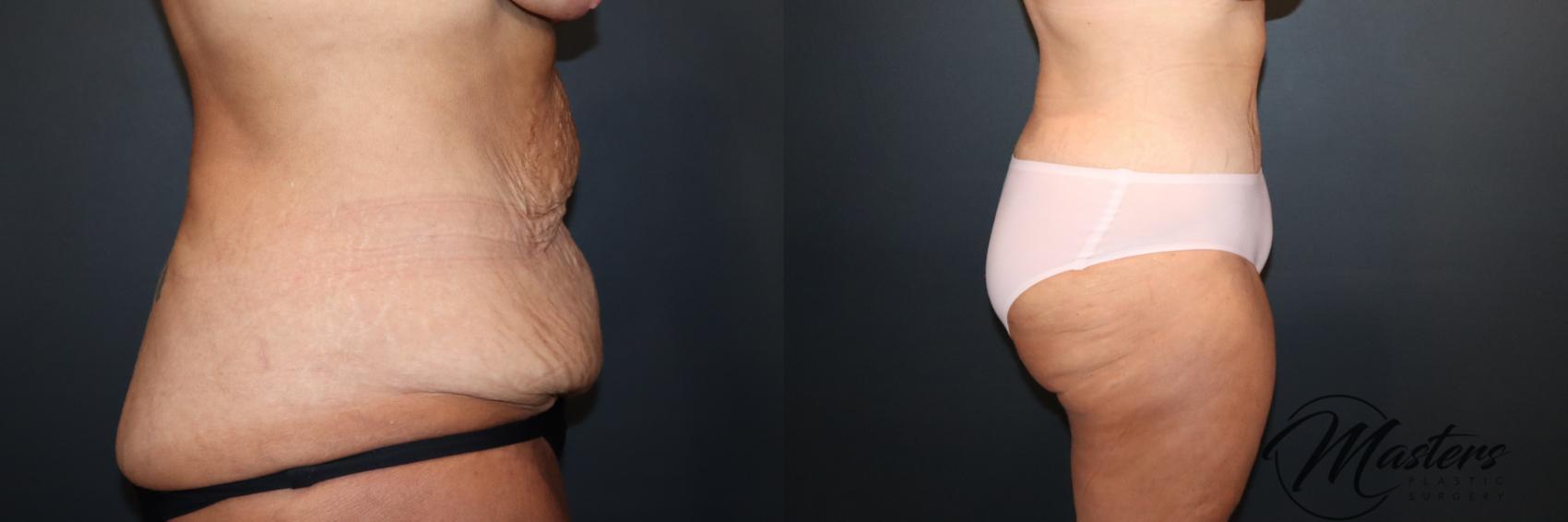 Fleur De Lis Tummy Tuck 