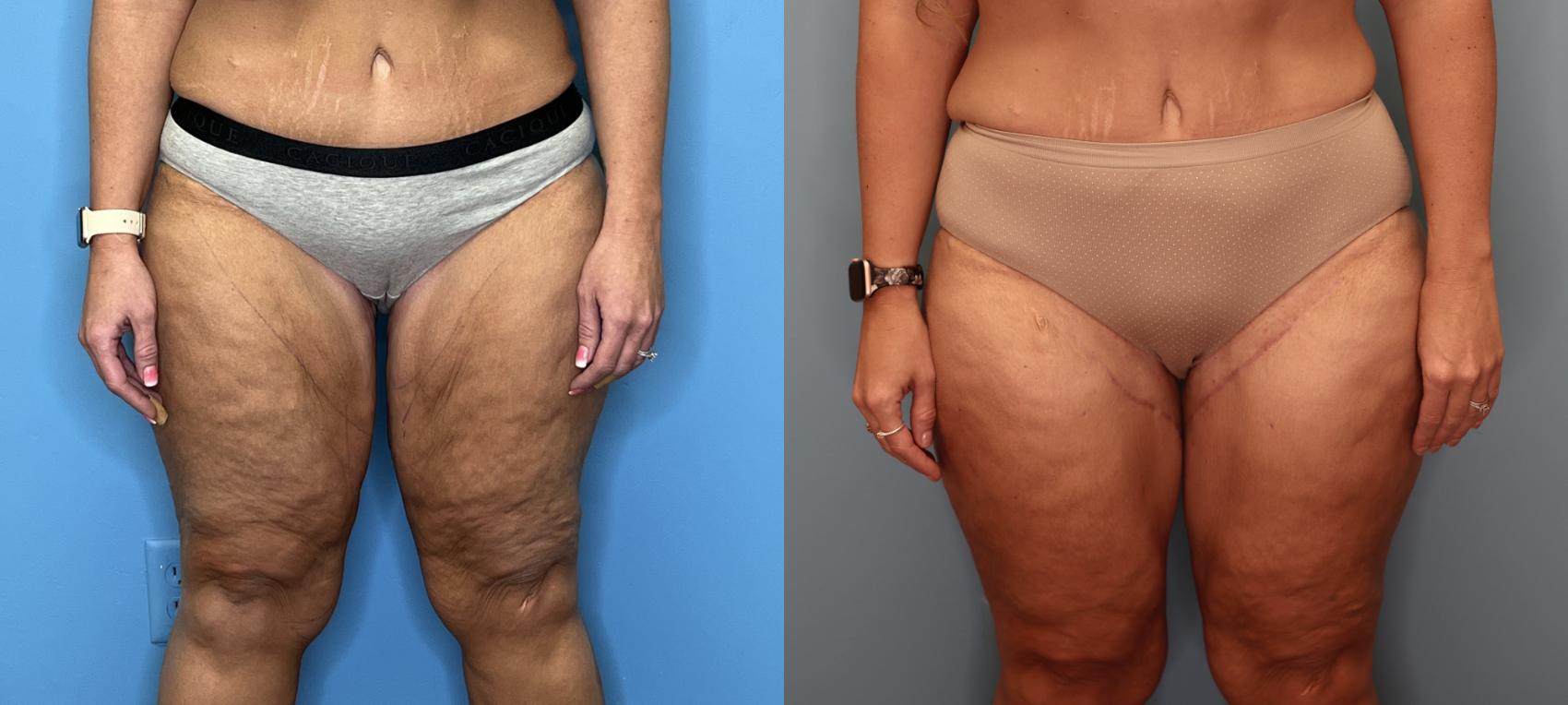 Before & After Thighplasty or Thigh Lift  Case 86 Front View in Oklahoma City, Tulsa, Norman, OK