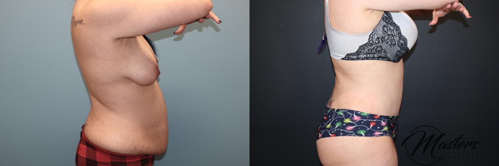 Tummy Tuck 