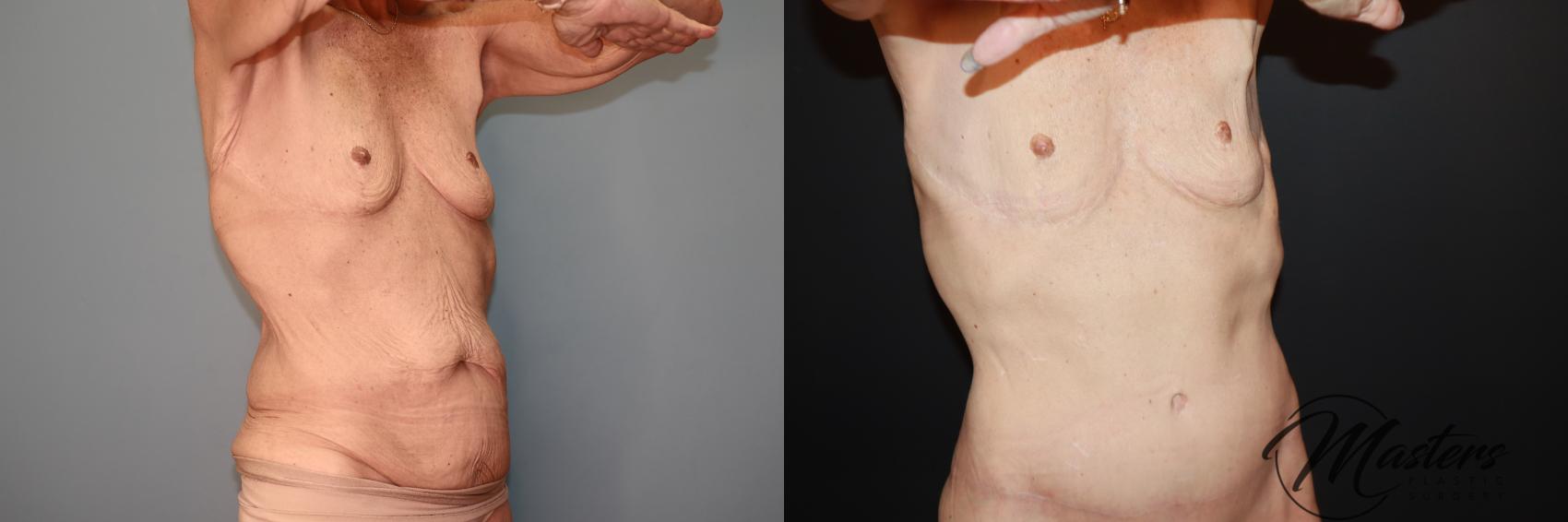  Tummy tuck