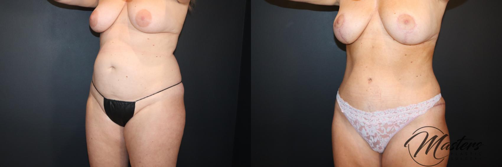 Tummy Tuck