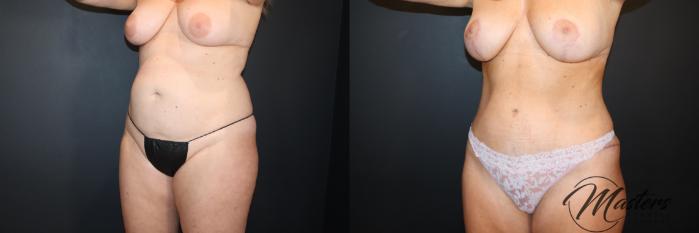 Tummy Tuck