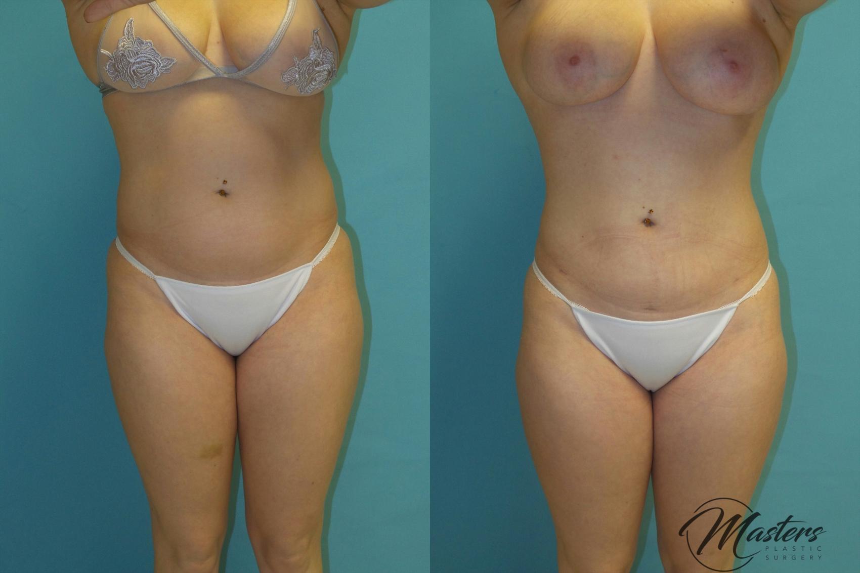 Before & After Tummy Tuck Case 12 Front View in Oklahoma City, Tulsa, Norman, OK