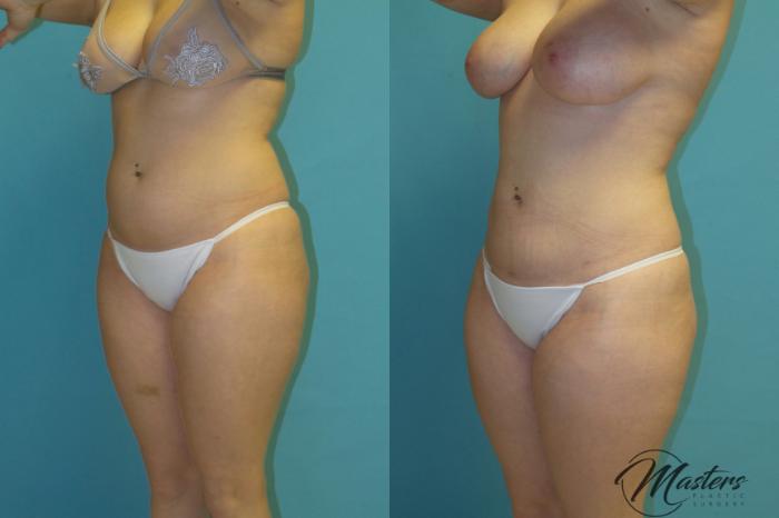 Before & After Tummy Tuck Case 12 Left Oblique View in Oklahoma City, Tulsa, Norman, OK