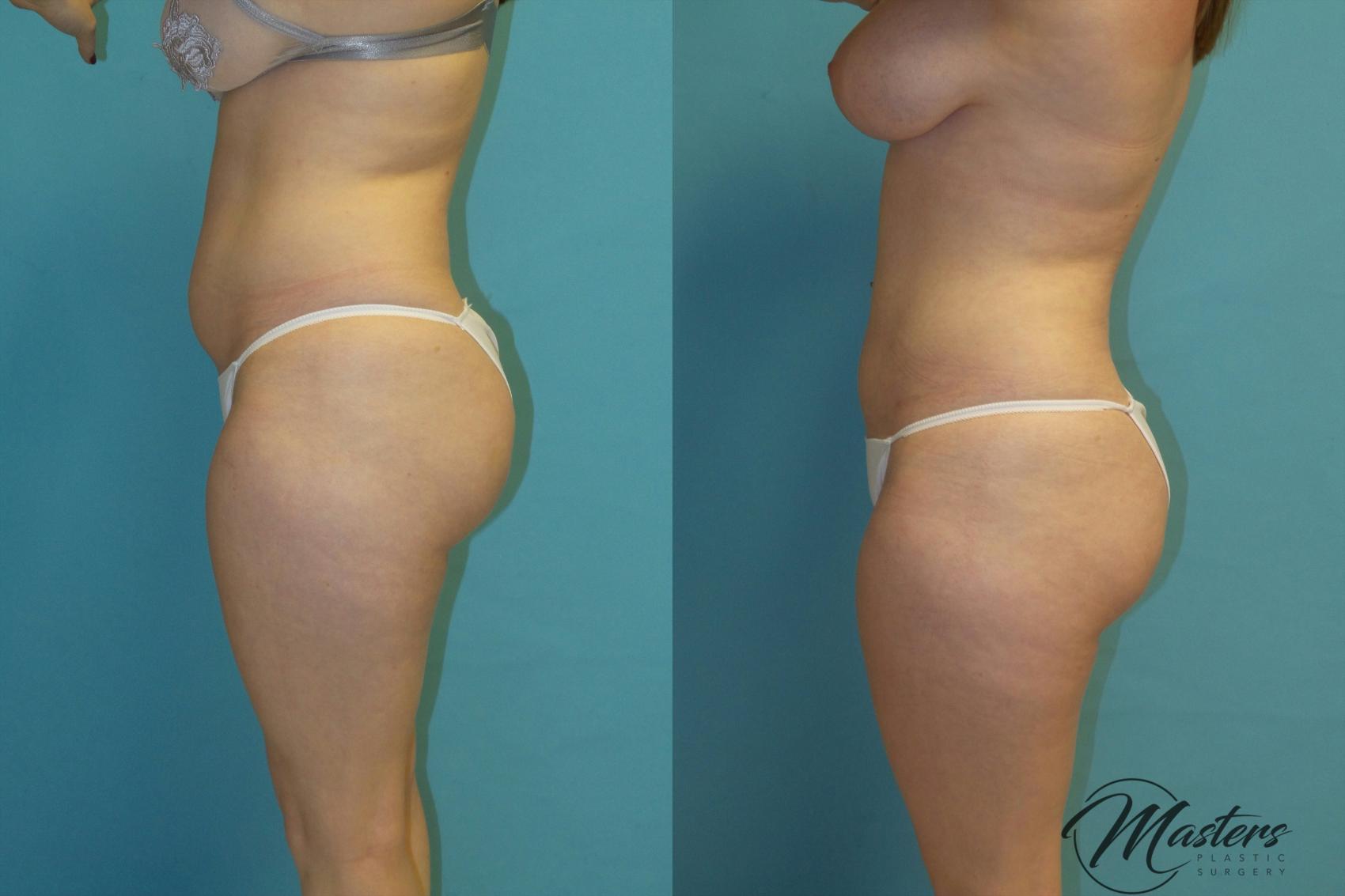 Before & After Tummy Tuck Case 12 Left Side View in Oklahoma City, Tulsa, Norman, OK
