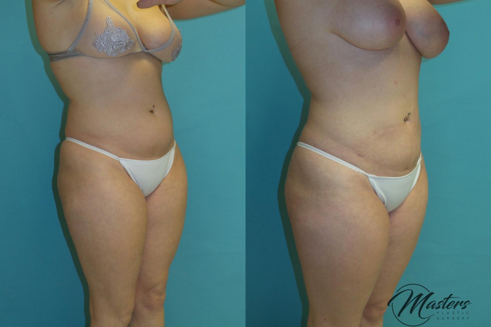 Before & After Tummy Tuck Case 12 Right Oblique View in Oklahoma City, Tulsa, Norman, OK