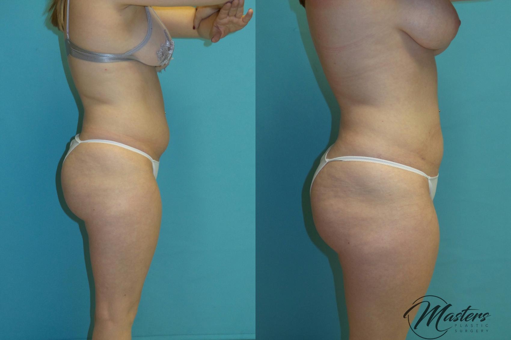Before & After Tummy Tuck Case 12 Right Side View in Oklahoma City, Tulsa, Norman, OK