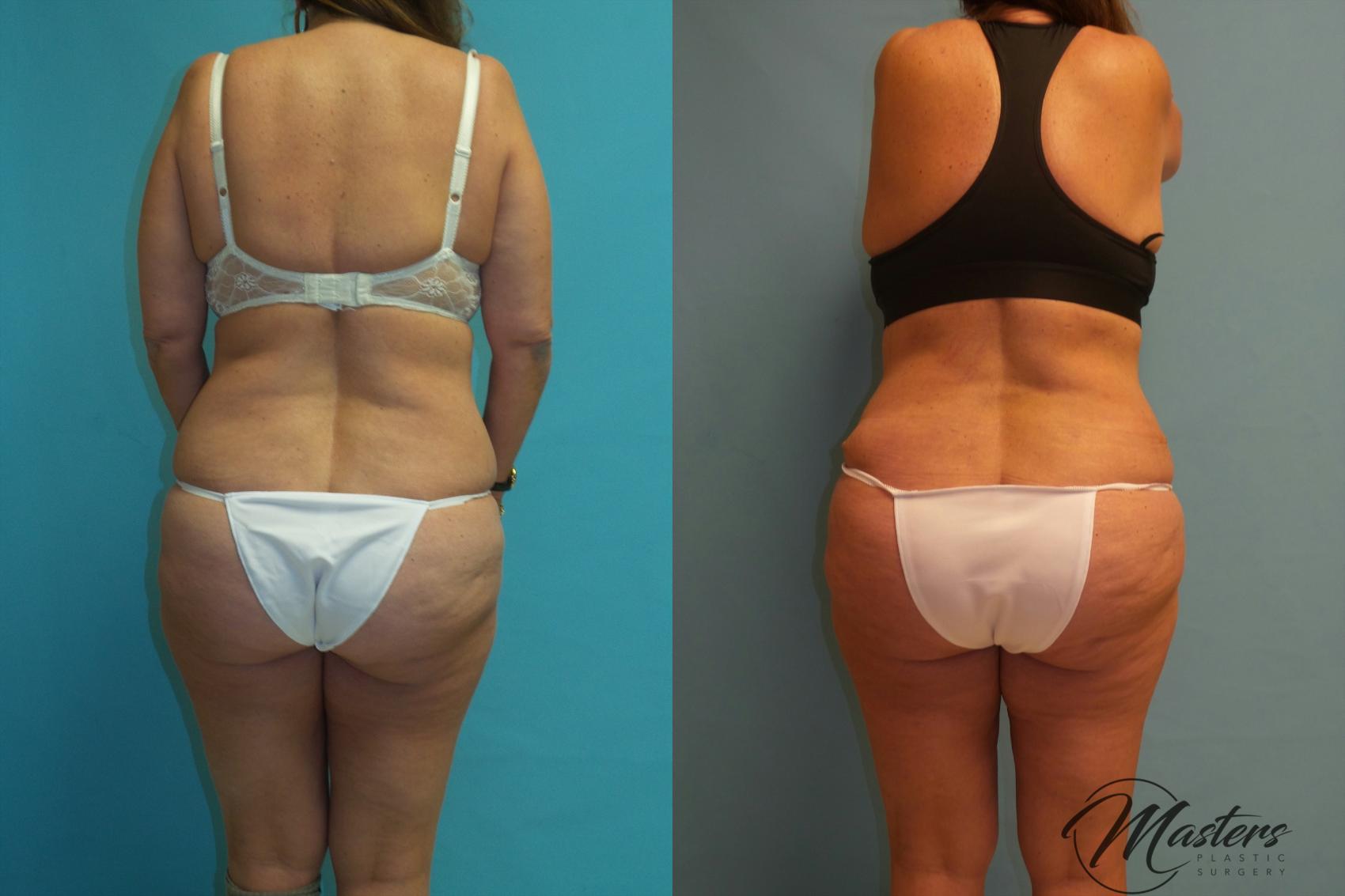 Before & After Tummy Tuck Case 13 Back View in Oklahoma City, Tulsa, Norman, OK