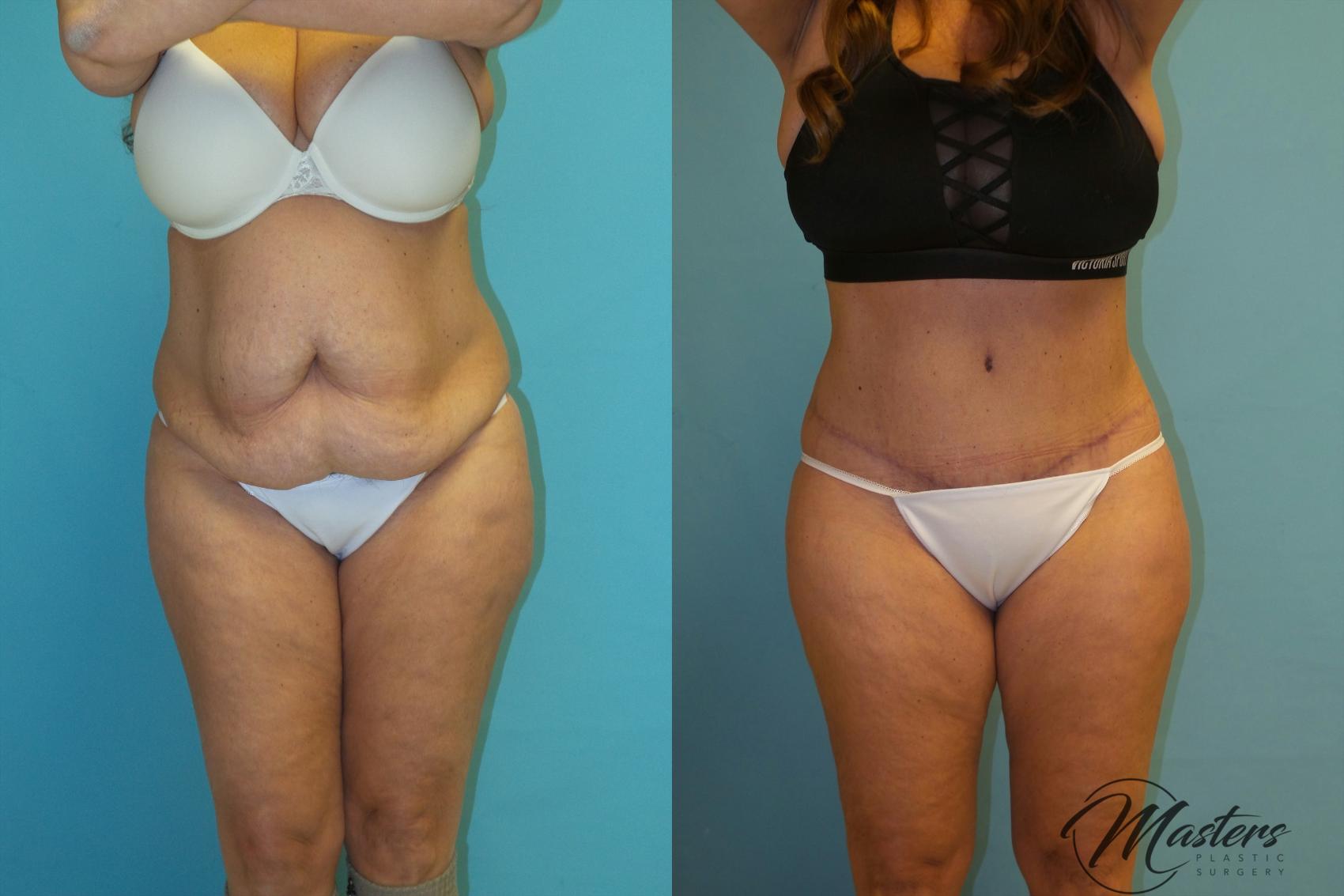 Before & After Tummy Tuck Case 13 Front View in Oklahoma City, Tulsa, Norman, OK