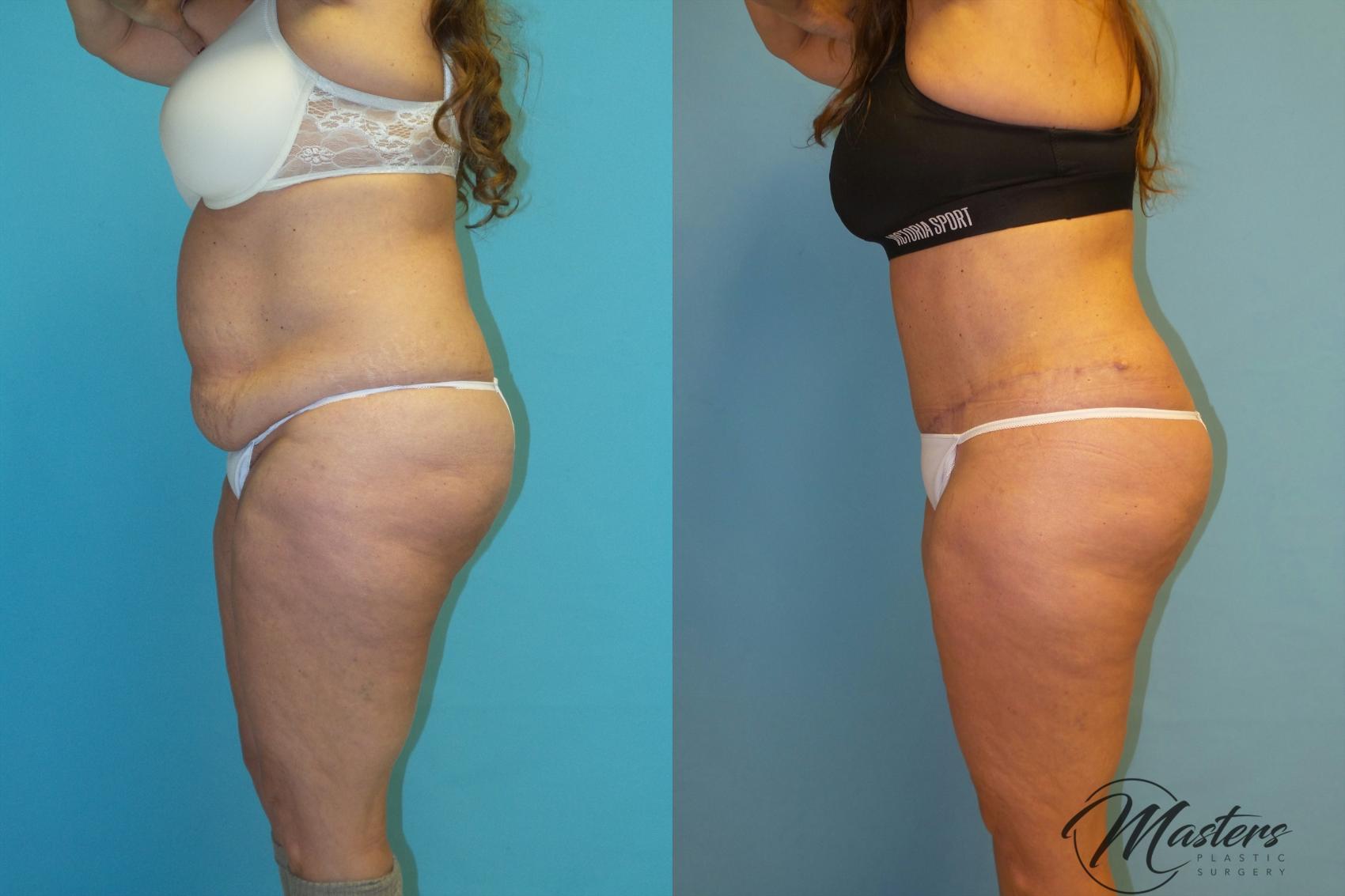 Before & After Tummy Tuck Case 13 Left Side View in Oklahoma City, Tulsa, Norman, OK
