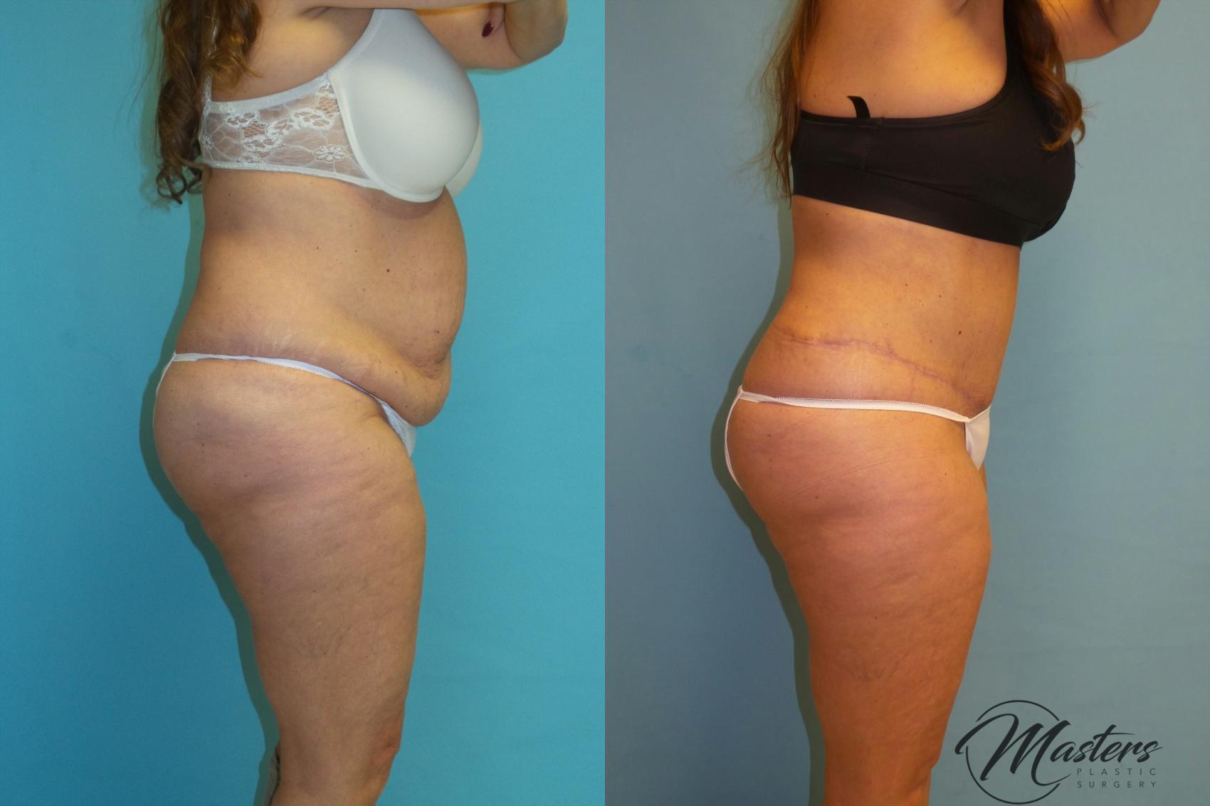 Before & After Tummy Tuck Case 13 Right Side View in Oklahoma City, Tulsa, Norman, OK