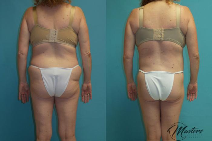 Before & After Tummy Tuck Case 14 Back (Relaxed) View in Oklahoma City, Tulsa, Norman, OK