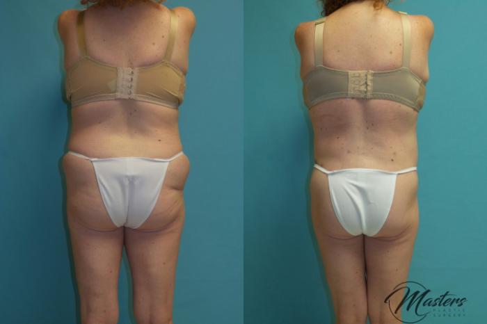 Before & After Tummy Tuck Case 14 Back View in Oklahoma City, Tulsa, Norman, OK