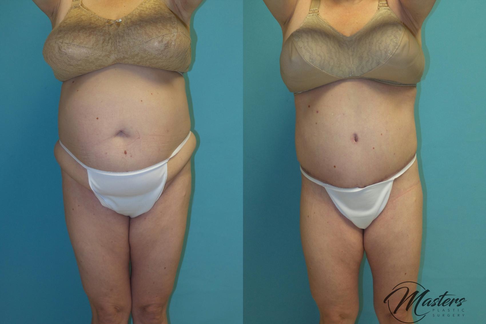 Before & After Tummy Tuck Case 14 Front View in Oklahoma City, Tulsa, Norman, OK